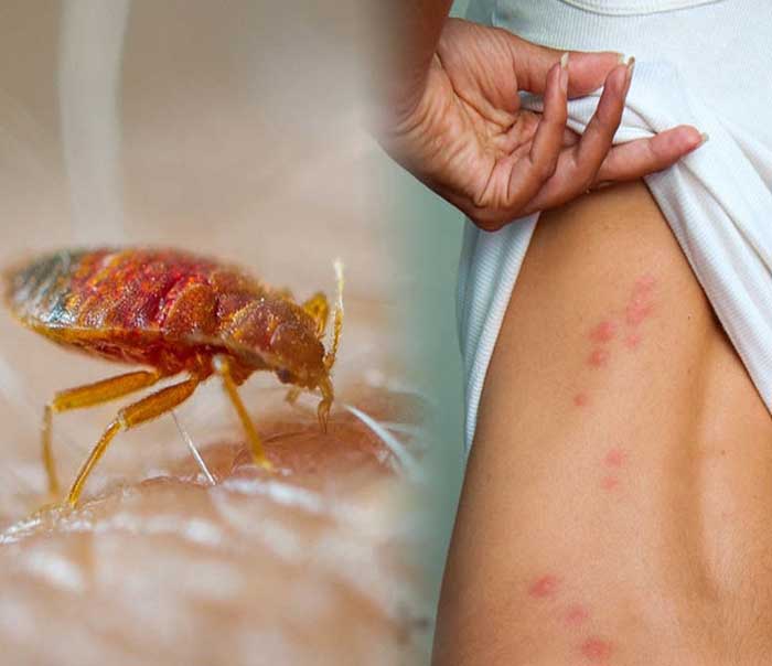 Dấu hiệu đầu tiên có thể nhận biết khi bạn vừa ngủ dậy là các vết cắn với triệu chứng ngứa nổi bật