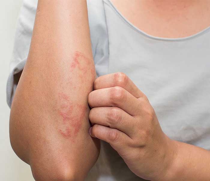 Có rất nhiều nguyên nhân khiến bạn nằm nệm bị ngứa